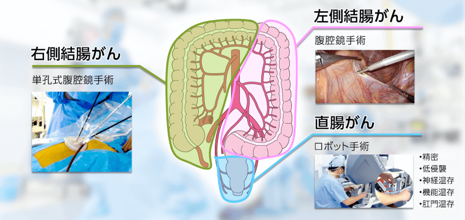 大腸がん手術の術式の種類