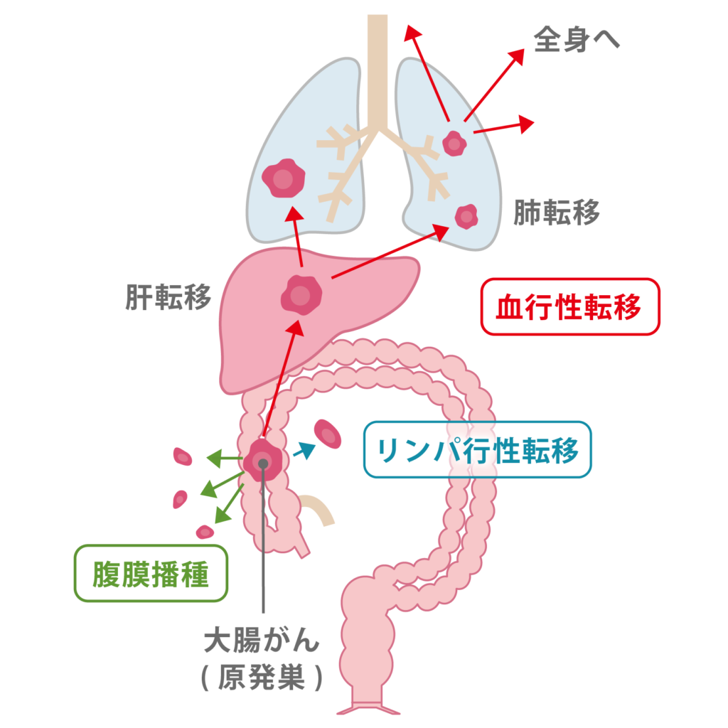 大腸がんの基礎知識 大阪急性期 総合医療センター 消化器外科