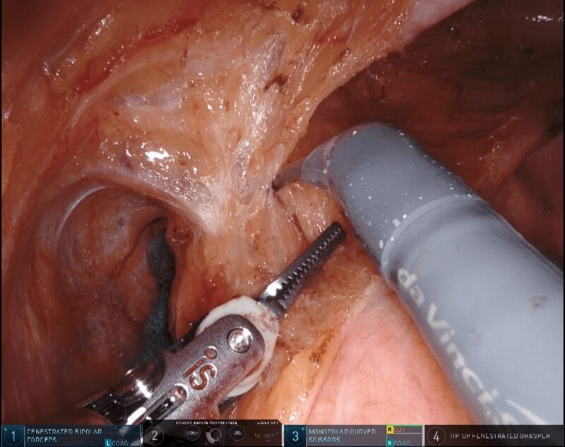 直腸がんに対するロボット手術（ダビンチ・da Vinci)4