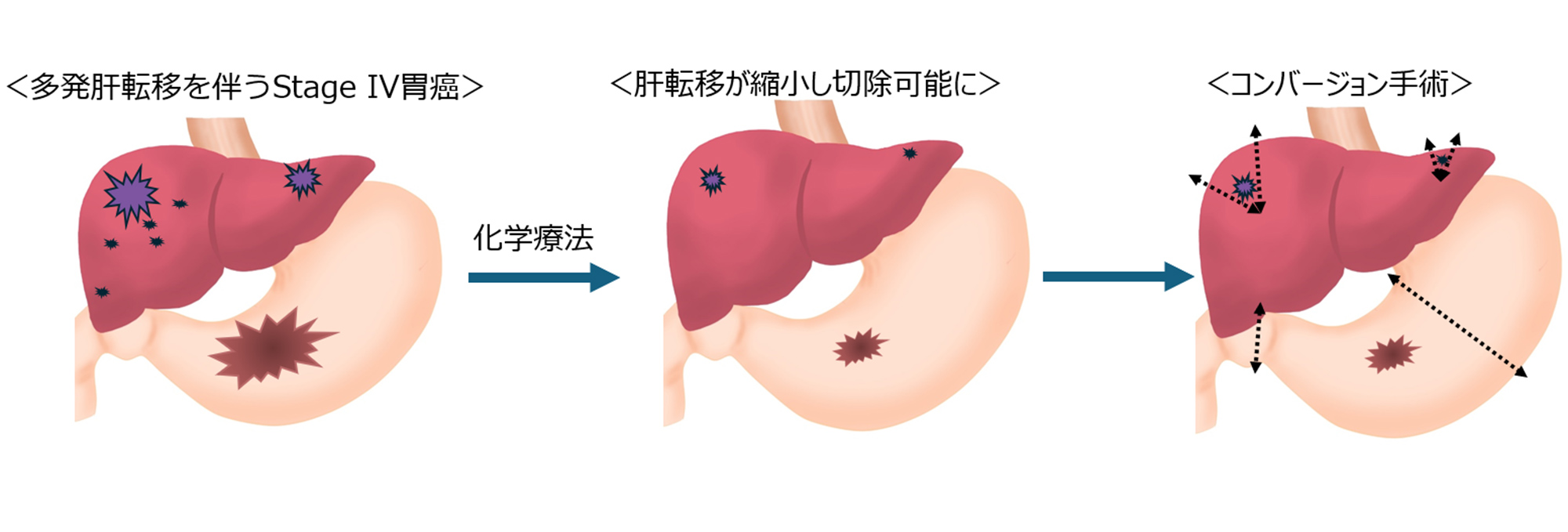 コンバージョン手術　図