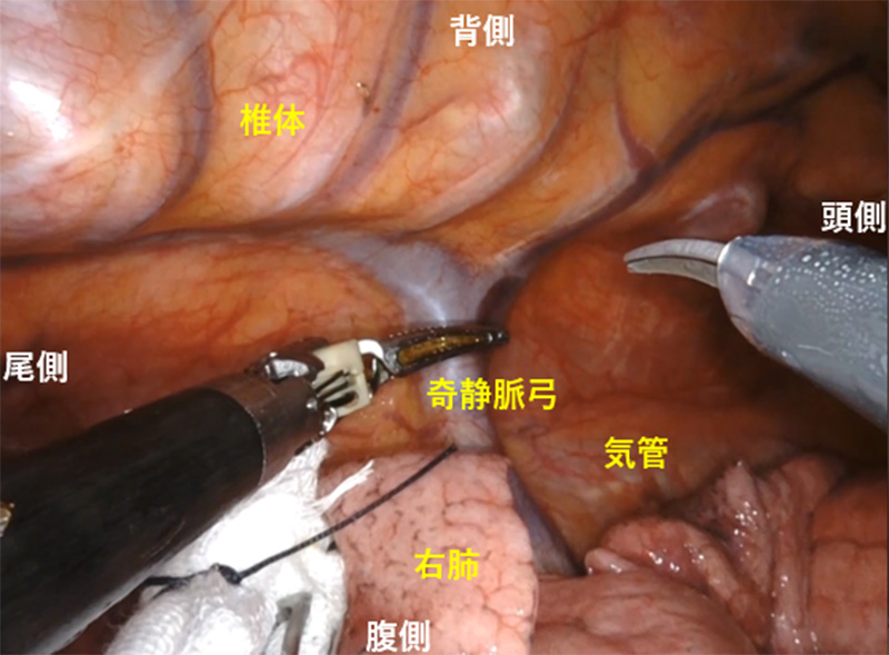 食道がん手術
