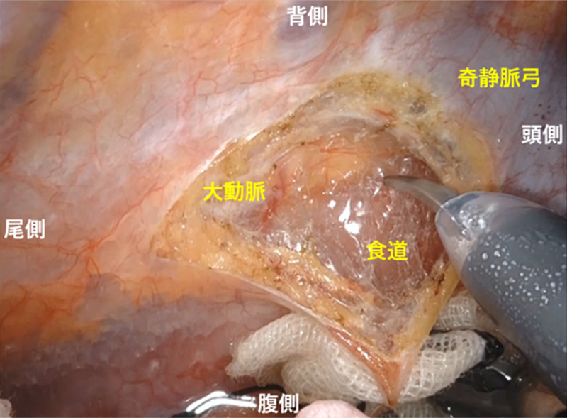 食道がん手術