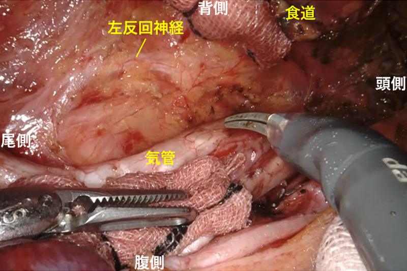 食道がん手術
